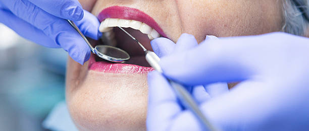 Best Knocked-Out Tooth (Avulsed Tooth) Treatment in Sunnyslope, WA